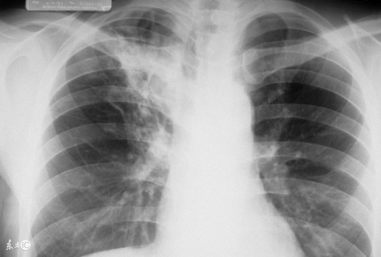 皮试验肺结核,皮试试