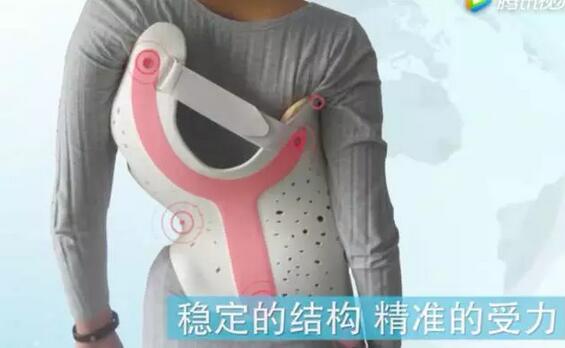 案例l3D打印支具助力青少年脊柱侧弯保守治疗
