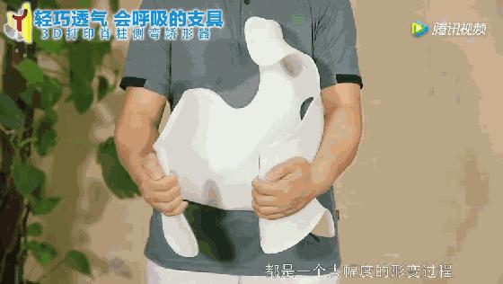 案例l3D打印支具助力青少年脊柱侧弯保守治疗