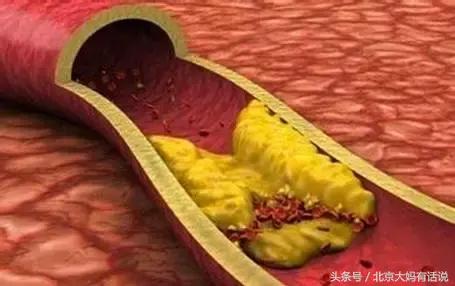 动脉硬化会导致白发吗,白发多吃黑米黑豆黑芝麻有改善吗