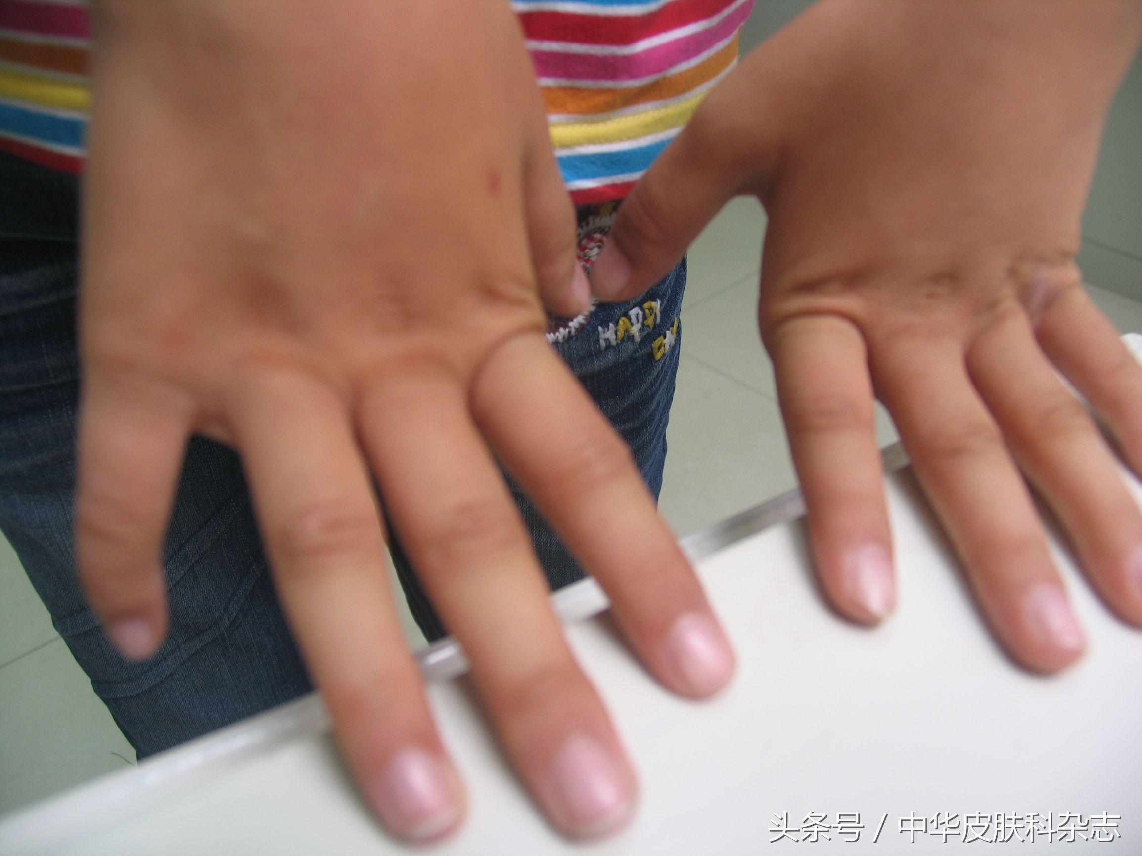 手部发黑怎么回事,摩擦性黑变病的症状有哪些