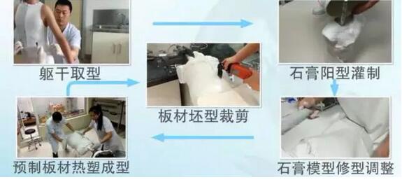 案例l3D打印支具助力青少年脊柱侧弯保守治疗