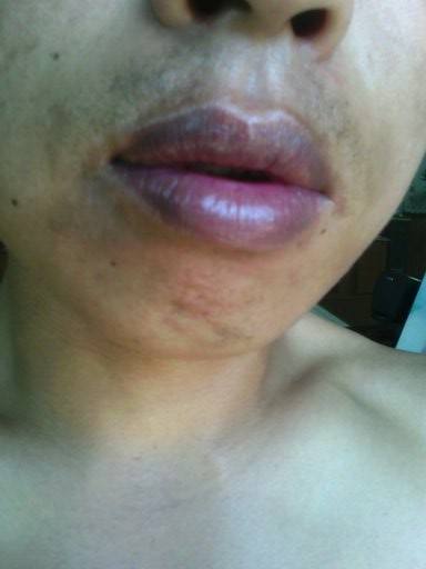 嘴唇发紫还有点发红,嘴唇发紫发白要不要漂唇