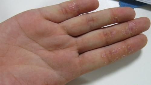 湿疹最怕的三种野菜,防秋燥的中药有哪些