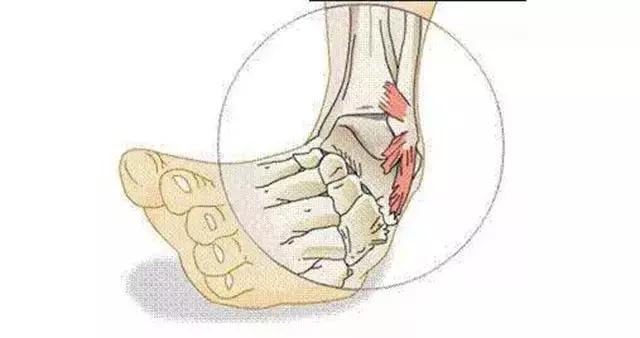 创伤性踝关节炎可能源自一次不经意的扭脚