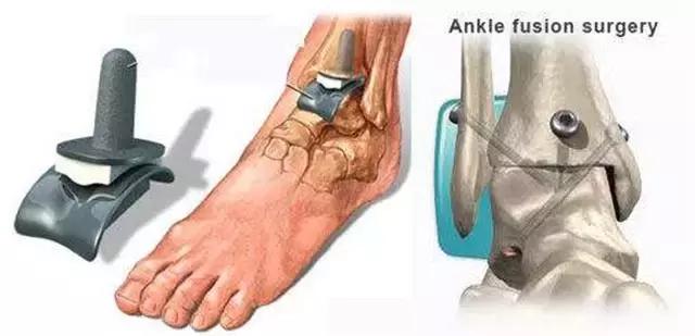 创伤性踝关节炎可能源自一次不经意的扭脚