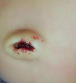 宝宝出生17天肚脐又出血了正常么,出生10天宝宝肚脐有点出血怎么办