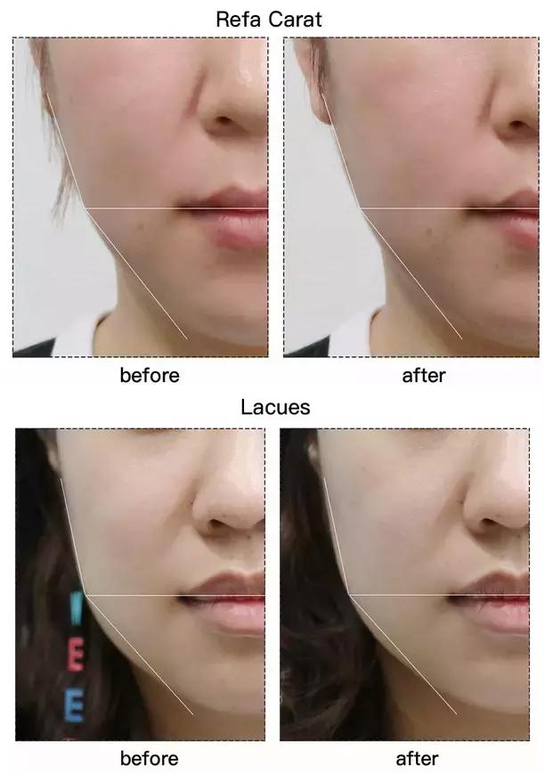 refacaratray瘦脸滚轮美容仪,refa进口滚轮瘦脸仪