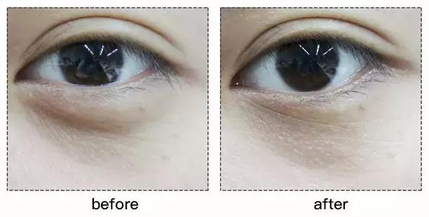 refacaratray瘦脸滚轮美容仪,refa进口滚轮瘦脸仪