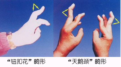 治疗类风湿性关节炎食疗方,类风湿性关节炎食疗菜谱