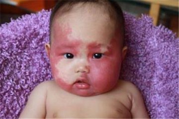 新生儿斑痣多久消退图,新生儿斑痣多久能消退