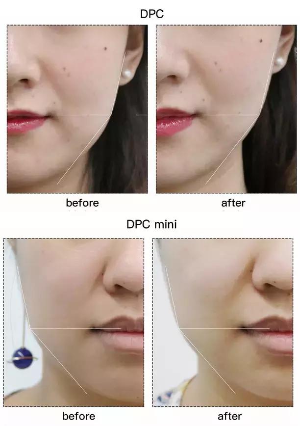 refacaratray瘦脸滚轮美容仪,refa进口滚轮瘦脸仪