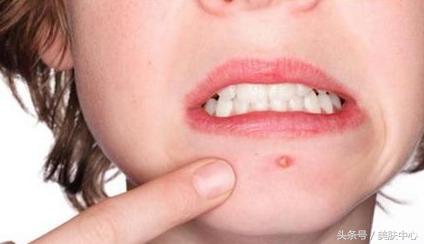 长期下巴痘痘去除小妙招,去下巴痘痘小妙招小学生