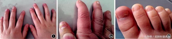 医学关于3岁小孩指甲脱落问题,儿童指甲大面积脱落图片