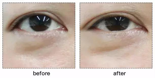 refacaratray瘦脸滚轮美容仪,refa进口滚轮瘦脸仪