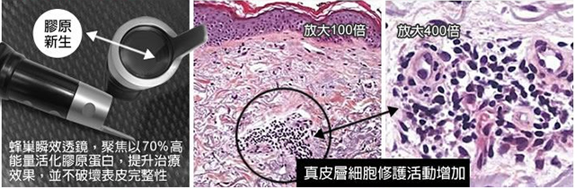 三角区痘疤的正确消除方法,专家告诉你怎么祛除脸上的痘痘