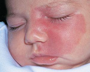 新生儿斑痣多久消退图,新生儿斑痣多久能消退