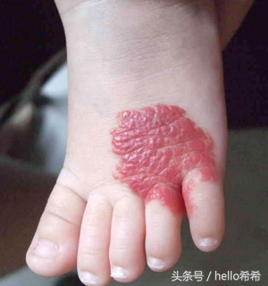 山西婴儿血管瘤最佳治疗,山西长峰血管瘤医院