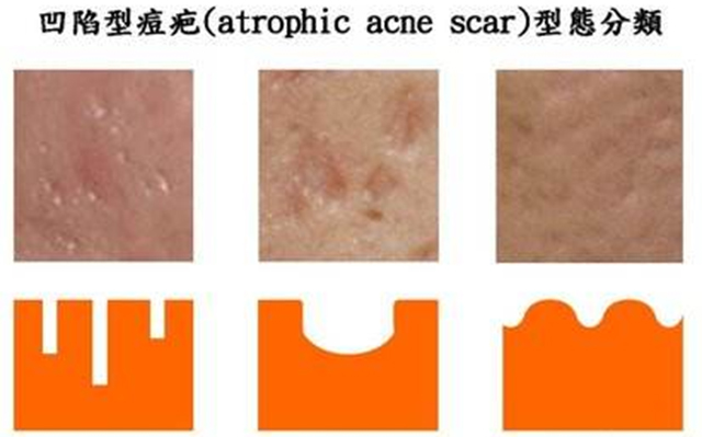 三角区痘疤的正确消除方法,专家告诉你怎么祛除脸上的痘痘