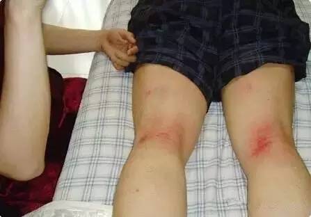 湿气重怎么办最快最有效的办法,湿气重怎么办一个小方法轻松搞定