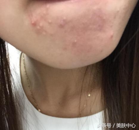 长期下巴痘痘去除小妙招,去下巴痘痘小妙招小学生