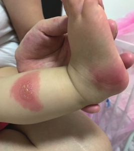 娃娃被蚊子叮咬后全身长满红色小疙瘩，秋蚊子咬人更“狠毒”