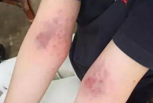 湿气重怎么办最快最有效的办法,湿气重怎么办一个小方法轻松搞定