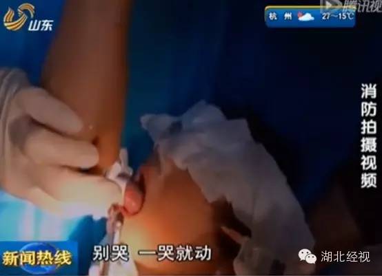 6岁宝宝喝水，不慎将舌头卡住瓶盖至血肿僵硬