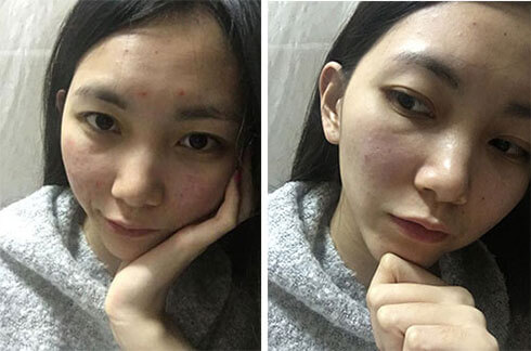 跟我这样做，不出3个月，痘痘全消散
