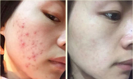 跟我这样做，不出3个月，痘痘全消散