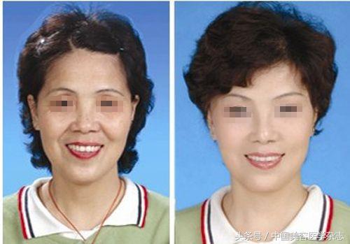 超声刀可以除皱吗,超声刀后面部凹陷还能恢复吗