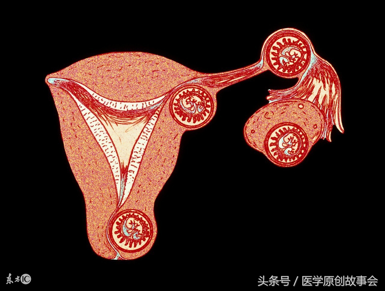 17岁少女腹痛难忍，凌晨突发意外，医生全力抢救仍未能挽回！