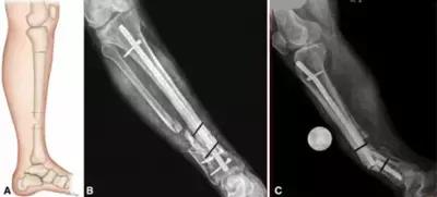 骨折多月了始终不愈合？！骨不连的危害真的有这么大？！