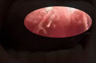 女性尖锐湿疣症状,尖锐性湿疣长嘴里会怎么样