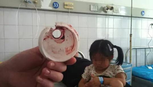 6岁宝宝喝水，不慎将舌头卡住瓶盖至血肿僵硬