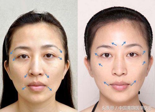 超声刀可以除皱吗,超声刀后面部凹陷还能恢复吗
