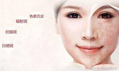 色斑的治疗方法,色斑分为哪几种怎么做可以淡化