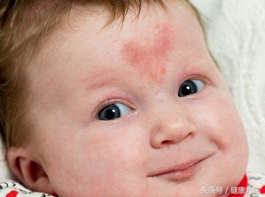 天生的胎记会不会癌变,胎记一定会癌变吗