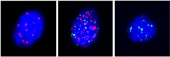 益善生物CanPatrol分型检测：CTC型别可预测早期乳腺癌淋巴结转移