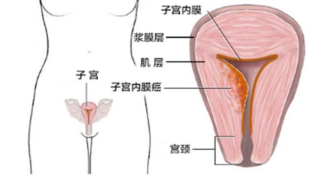 绝经后子宫内膜癌出血量大吗,绝经后出血一定是子宫内膜癌吗