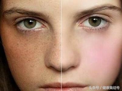 色斑的治疗方法,色斑分为哪几种怎么做可以淡化