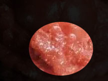 女性尖锐湿疣症状,尖锐性湿疣看什么科