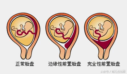 完全性前置胎盘的亲身经历,完全性前置胎盘的生产经历