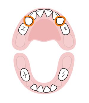宝宝长牙顺序和换牙顺序一样吗,宝宝换牙有什么征兆