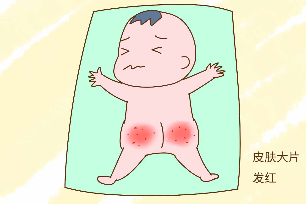 宝宝红屁屁破皮起疹子,宝宝红屁股淹脖子用什么