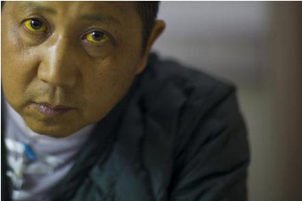 通过尿液判断疾病,自己的尿液能看出来癌症吗