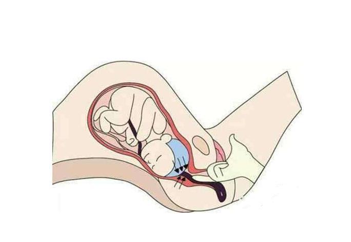 顺产分娩如何避免各种尴尬,顺产必须面对的五大尴尬