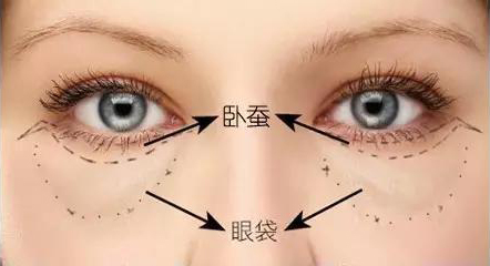 黑眼圈或眼袋很重？20几岁的年纪怎么办？