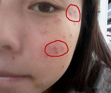 脸上痘痘硬硬的一直不消怎么办,生产后脸上痘痘不消怎么办