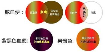 无痛性便血的原因，你了解吗？